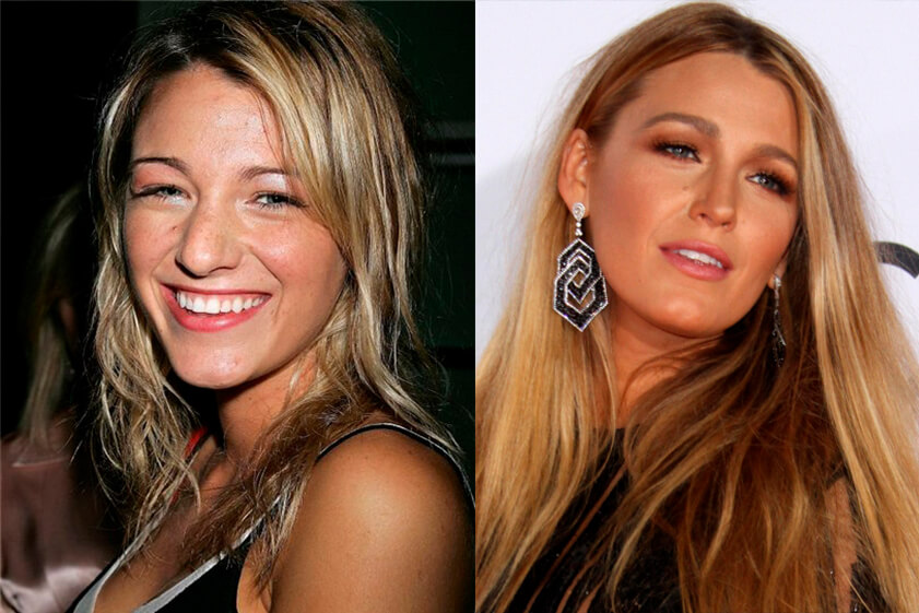 Блейк Лайвли до&nbsp;и&nbsp;после ринопластики