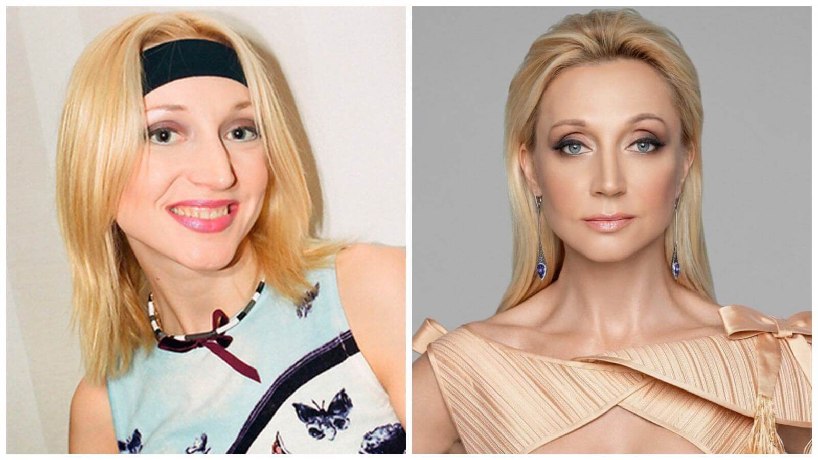 Кристина Орбакайте до&nbsp;и&nbsp;после ринопластики