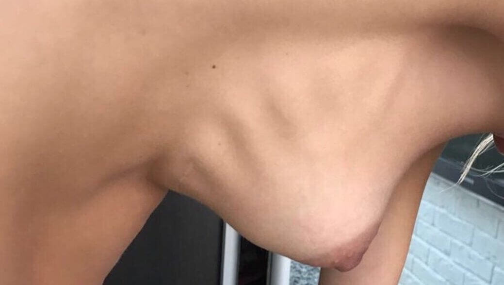 Рябь на груди чаще всего видна при наклонах и ходьбе