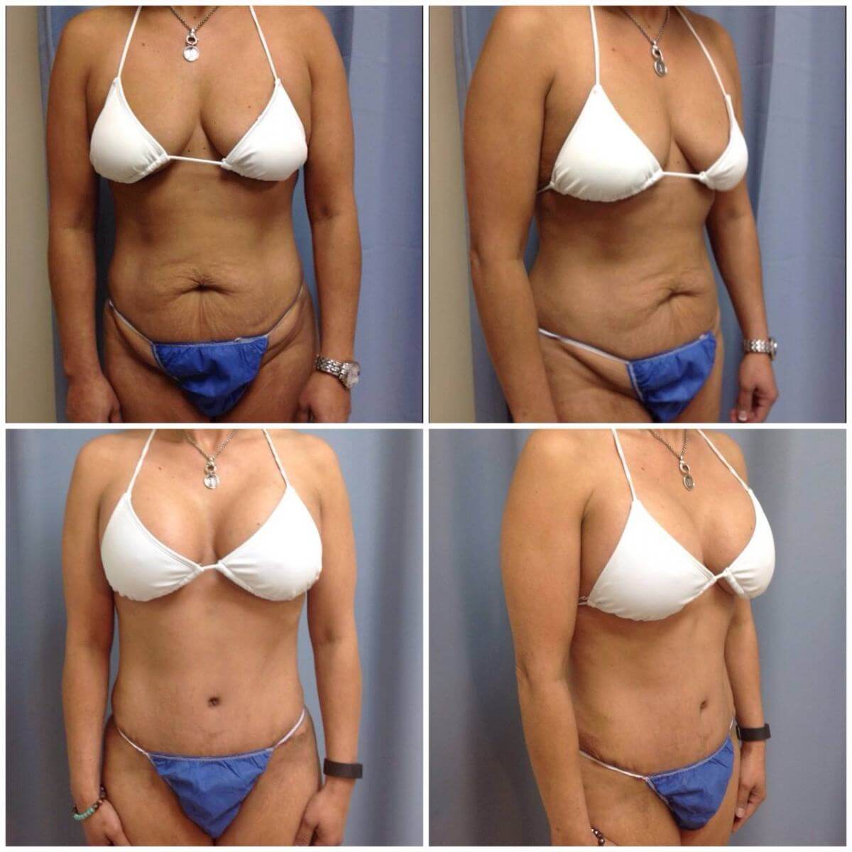 В белье результаты подтяжки груди выглядят впечатляюще. А что же под бюстгальтером?