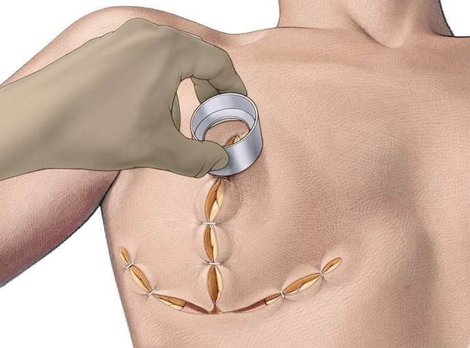 Так схематически выглядит якорный доступ при подтяжке груди