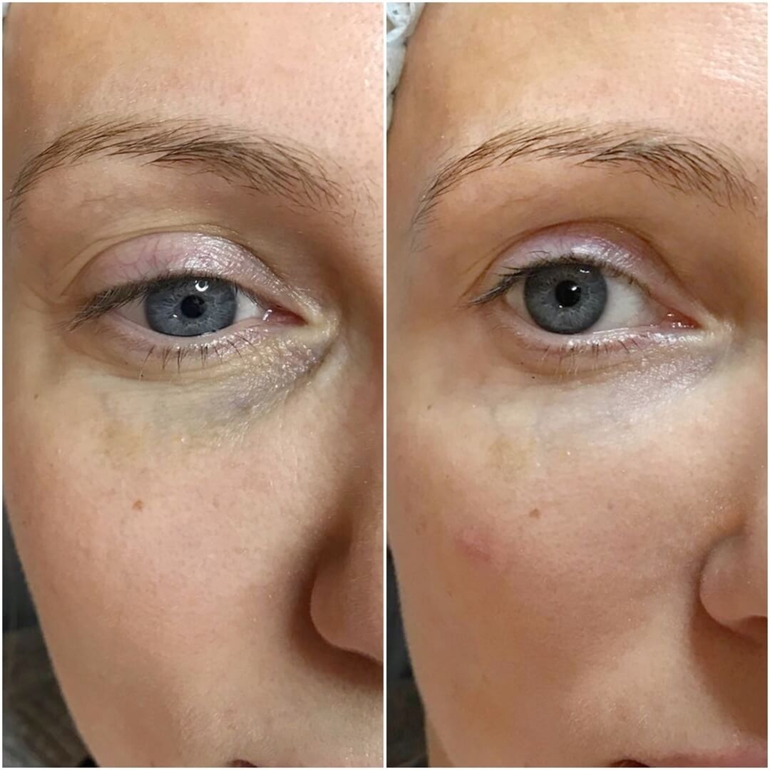 Липофилинг дает отличный результат в борьбе с синяками под глазами