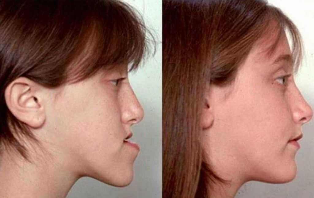 Устранение проблем с&nbsp;челюстями кардинально меняет внешность