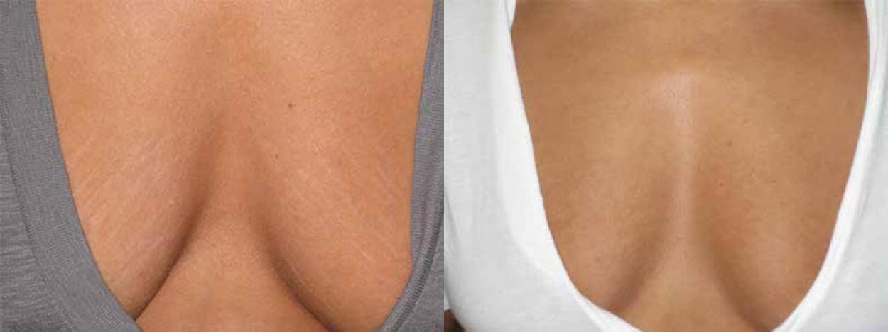 Современная косметология располагает целым пулом методов для&nbsp;борьбы с&nbsp;растяжками