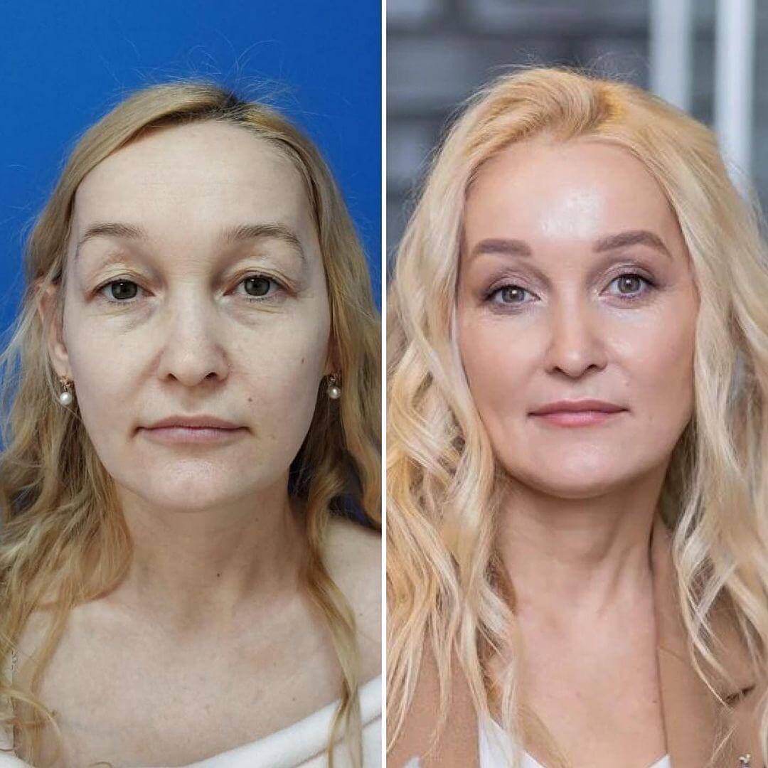 Блефаропластика преображает и омолаживает любое лицо