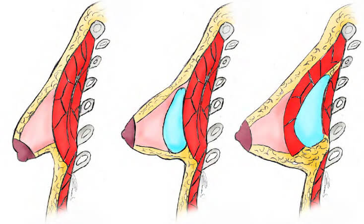 Тубулярность груди можно корректировать с помощью установки имплантов 