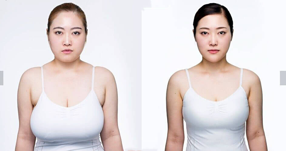 Уменьшение груди &ndash; процедура болезненная, но&nbsp;оно того стоит