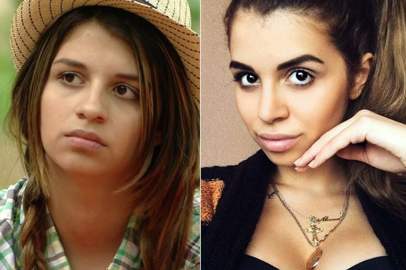 Алиана Устиненко после ринопластики