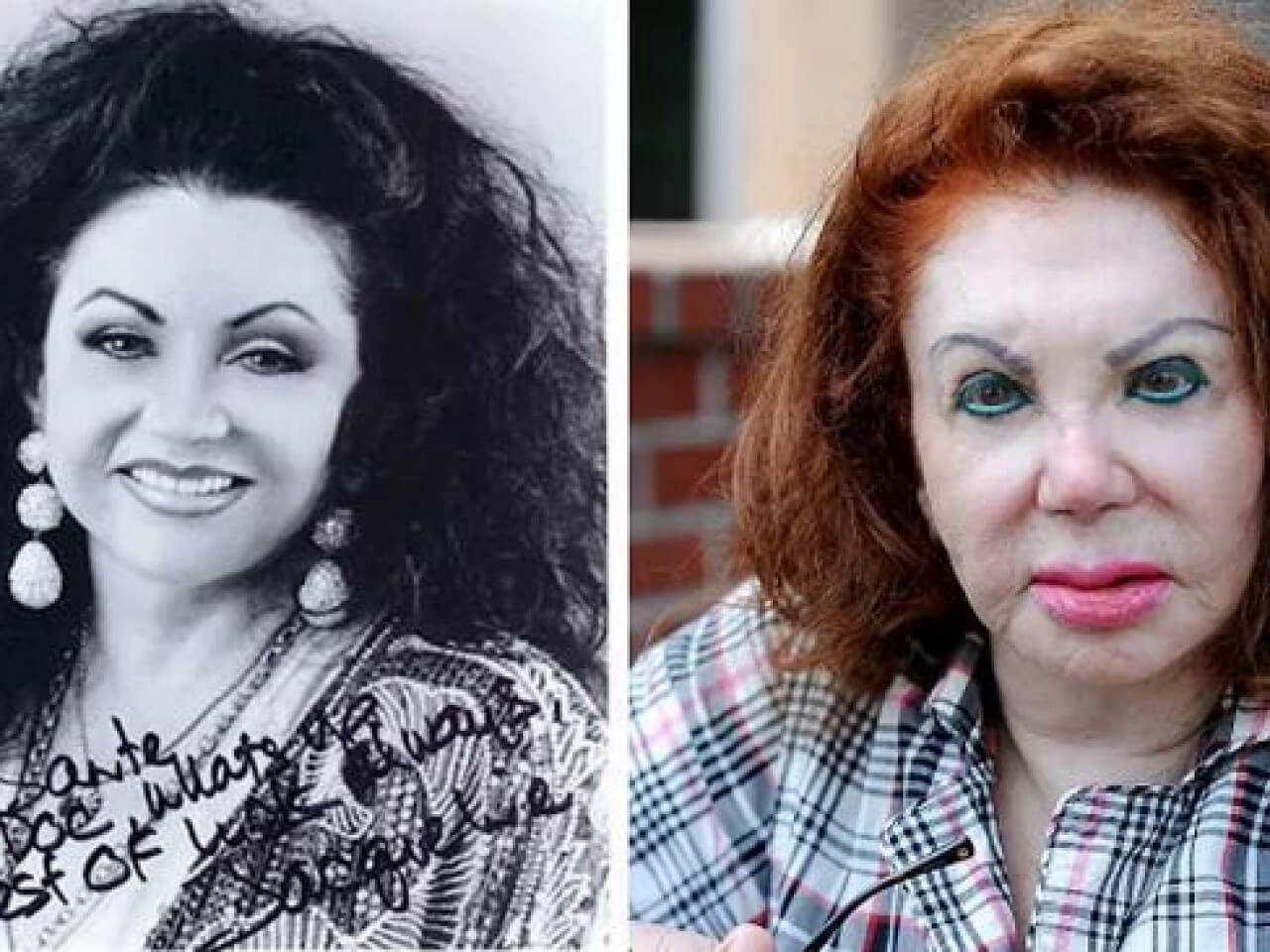 Жаклин Сталлоне до&nbsp;и&nbsp;после пластики