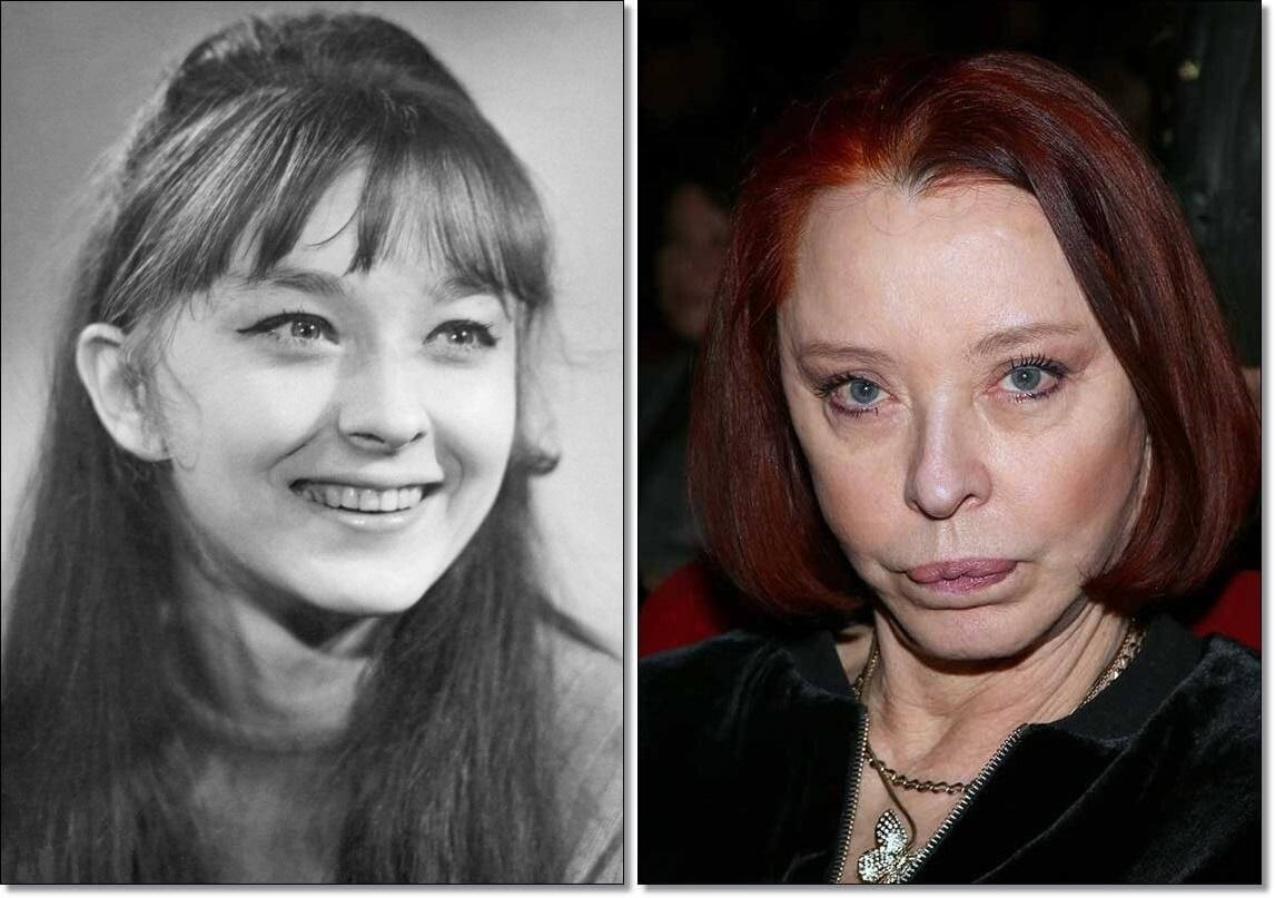 Анастасия Вертинская до&nbsp;и&nbsp;после пластики