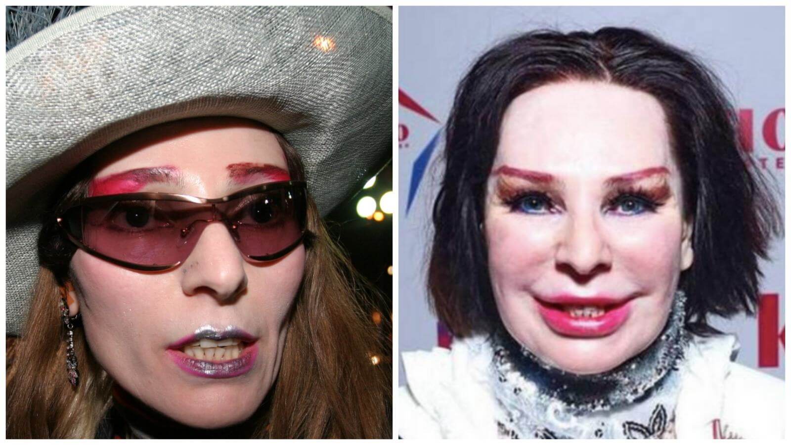 Жанна Агузарова до&nbsp;и&nbsp;после пластики