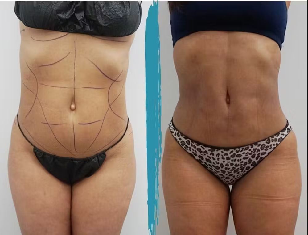 Vaser-липосакция превращает обычный животик в&nbsp;спортивный пресс