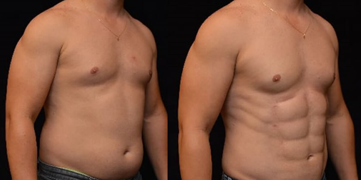 Кубики пресса, созданные с&nbsp;помощью липосакции