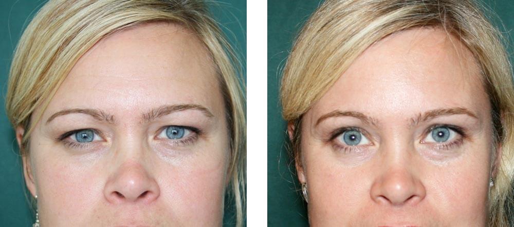 После верхней блефаропластики взгляд буквально распахивается