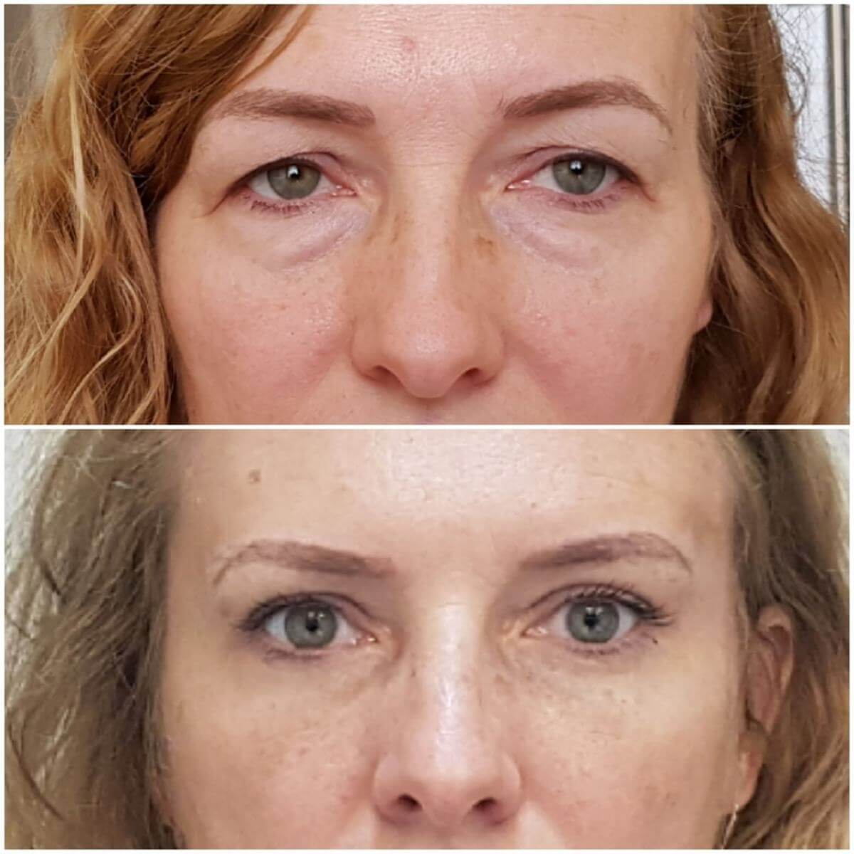 Височный лифтинг омолаживает самую склонную к возрастным изменениям зону – верхнюю треть лица и область глаз и бровей 