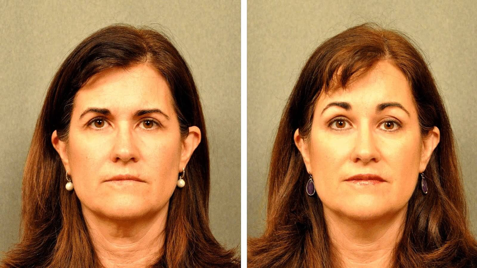 Броулифтинг &ndash; фото до&nbsp;и&nbsp;после операции