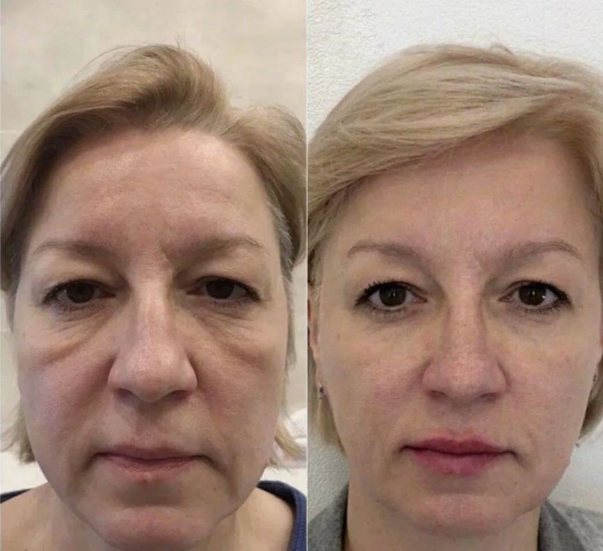 Добиться максимальных результатов от&nbsp;подтяжки бровей можно при комбинации процедуры с&nbsp;другими методами лифтинга