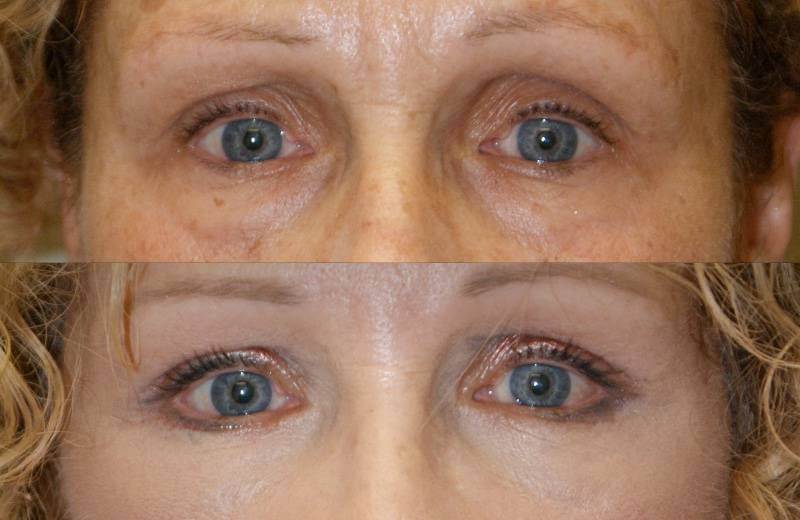 Блефаропластика+липофилинг – оптимальный вариант борьбы с эффектом впалых глаз