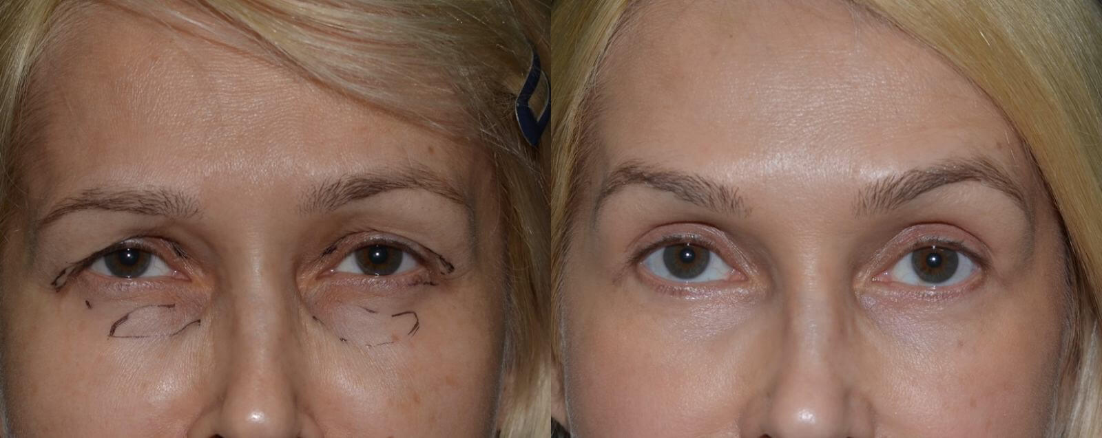 После пластики век и липофилинга глубоко посаженные глаза визуально становятся больше и выглядят гармоничнее