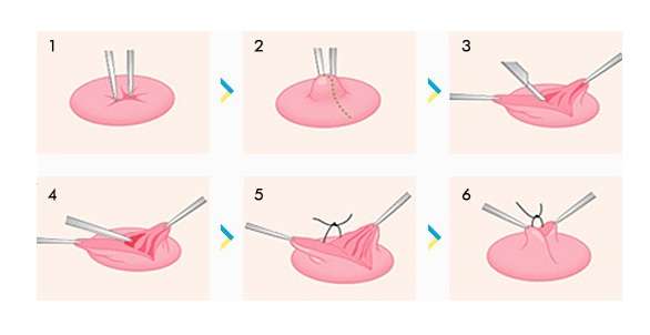 При проведении операции сосок буквально вытягивается из груди