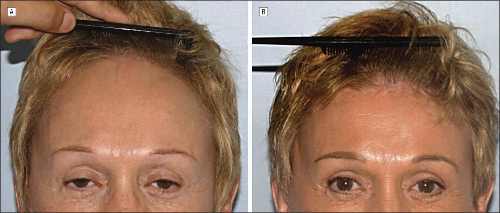 Обратная подтяжка лба снижает линию роста волос на несколько сантиметров