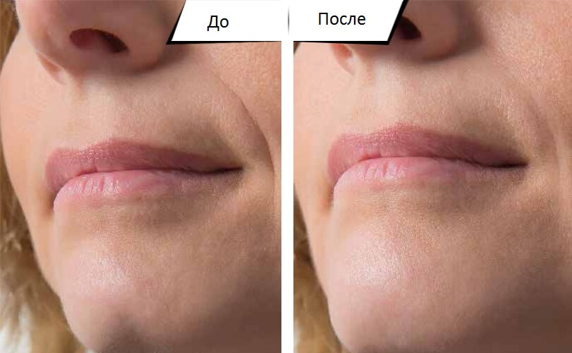 Коррекция ямочки на подбородке – до и после