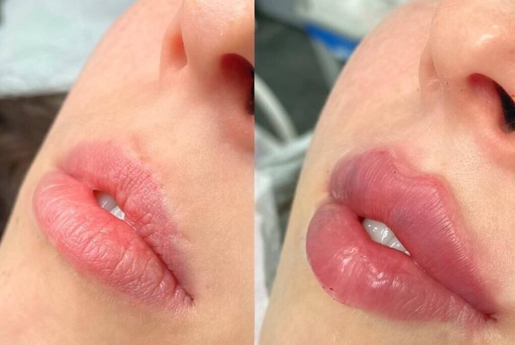 Больше всего техника увеличения &laquo;замочная скважина&raquo; подходит тем, у&nbsp;кого от&nbsp;природы &laquo;губы бантиком&raquo;