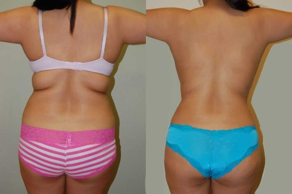 Иногда достаточно немного похудеть и подтянуть мышцы, чтобы складки на спине пропали