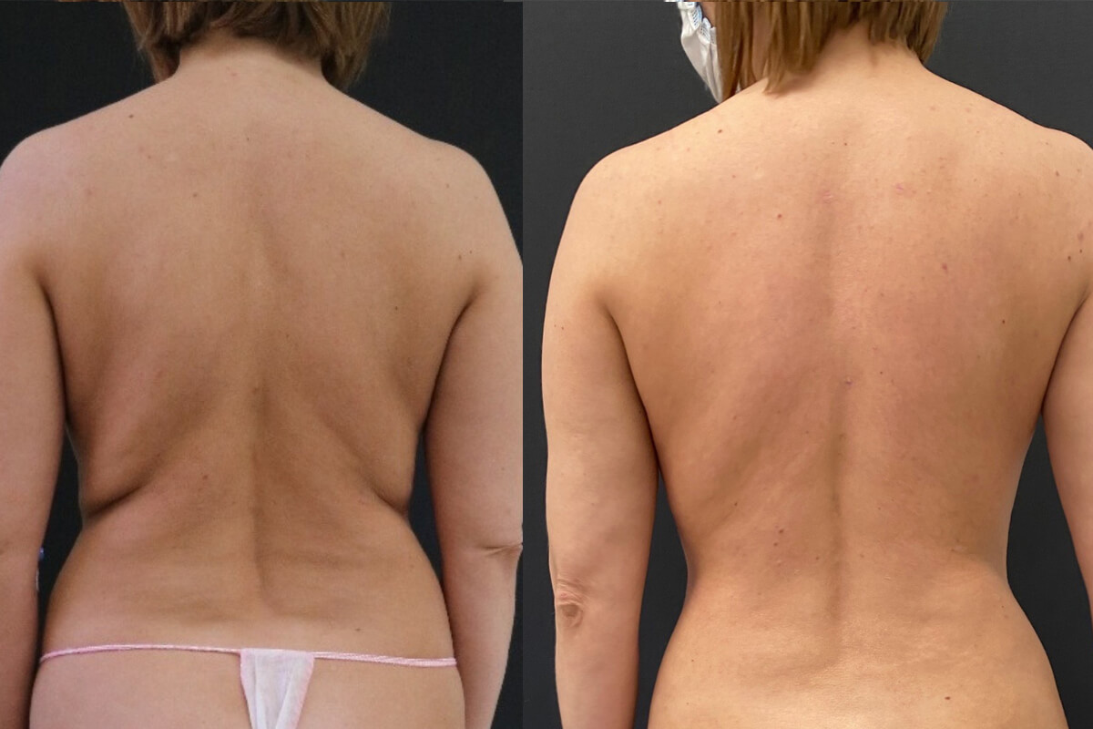 Липосакция – самый эффективный способ борьбы с жировыми складками и валиками на спине
