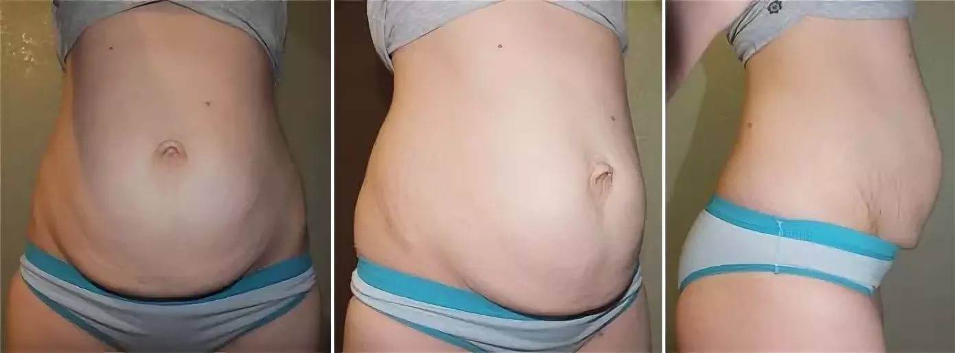 Диастаз, пупочная грыжа и складка над шрамом – проблема 3-в-1, которую может эффективно решить только абдоминопластика