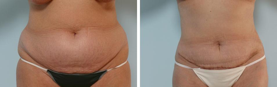 Абдоминопластика убирает не только жировую ткань над шрамом, но и обвисшую кожу