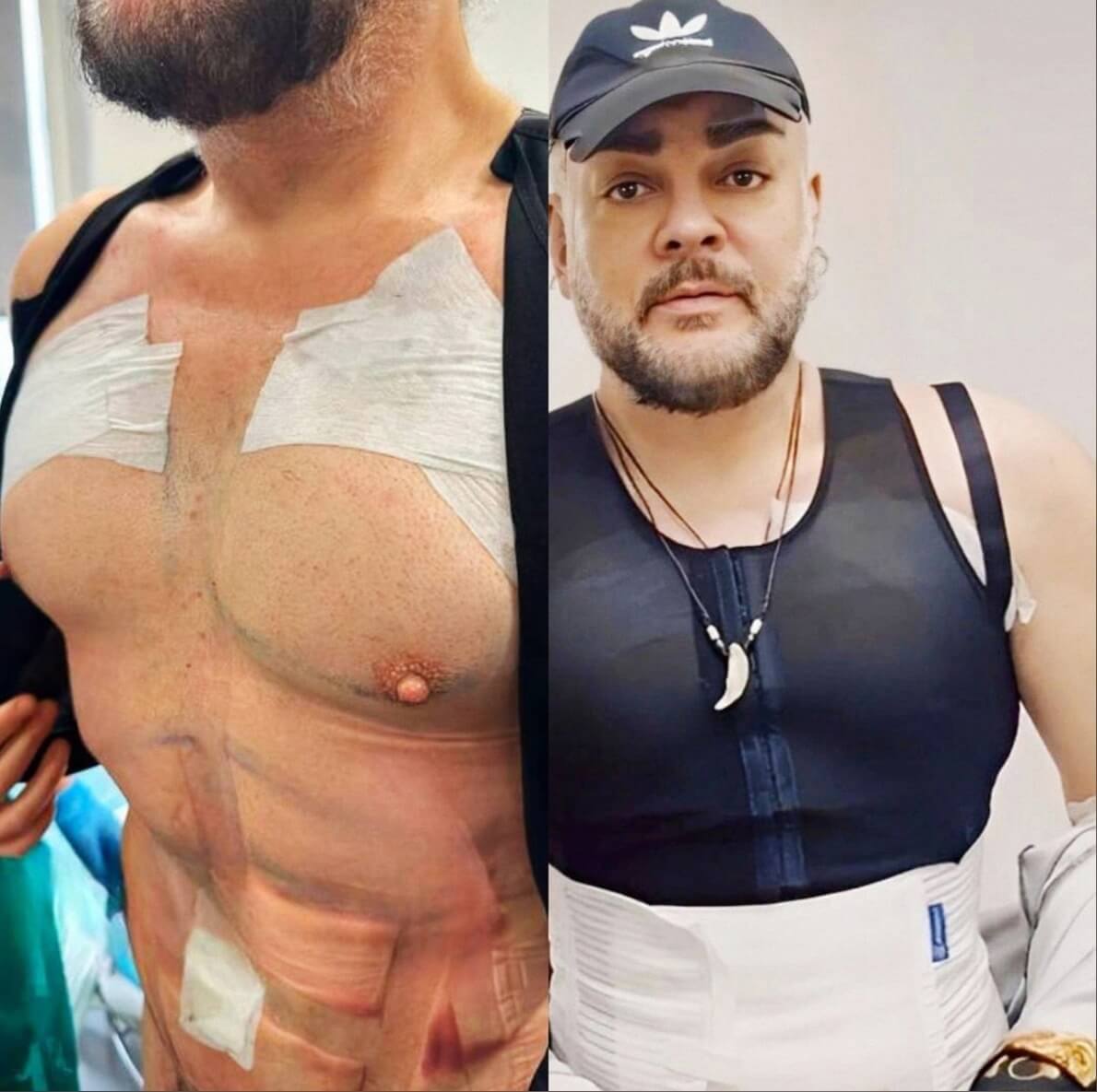 Филипп Киркоров после пластики в 2023 году