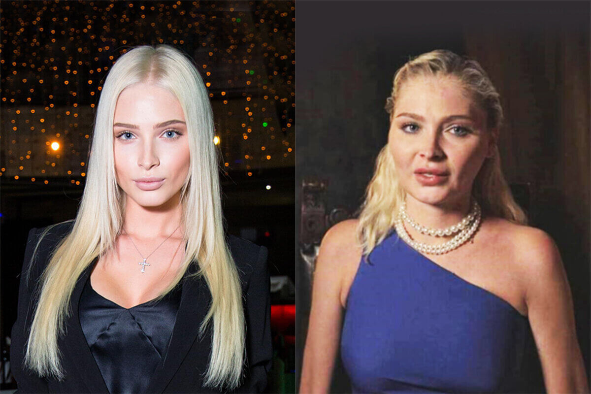 Алена Шишкова до и после пластики