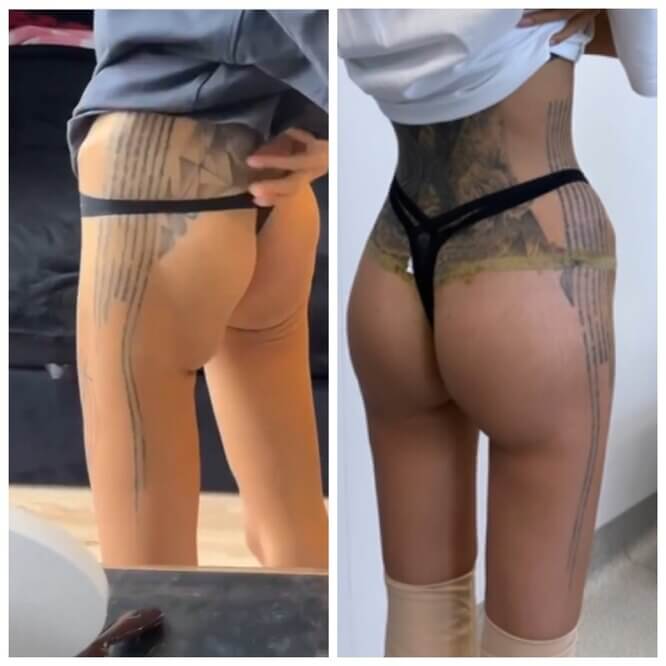 Алана Мамаева до и после коррекции ягодиц