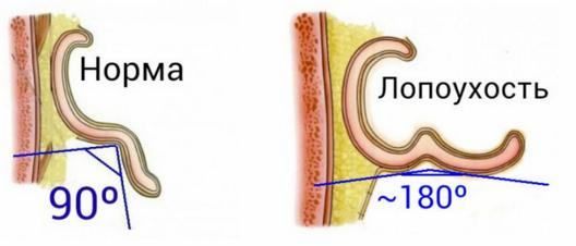 Степени лопоухости