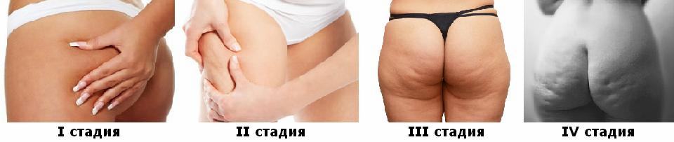 Стадии целлюлита