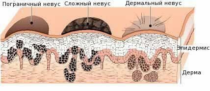 Расположение родинок на&nbsp;коже