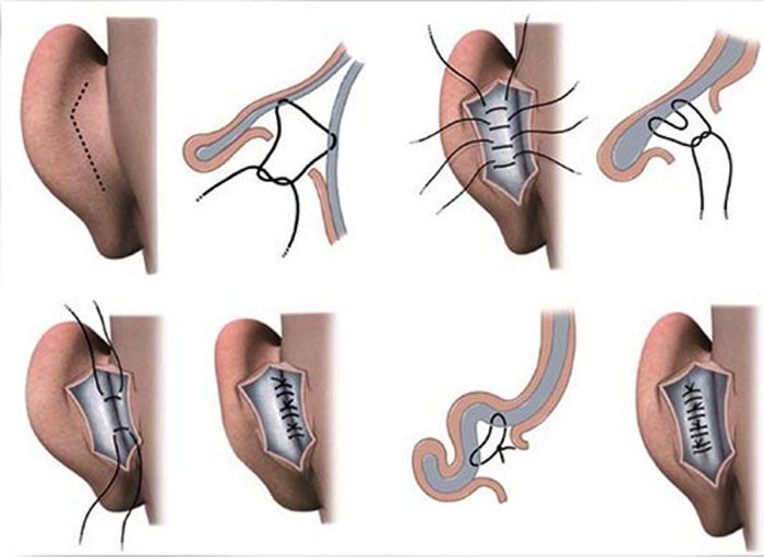 Что такое пластика ушей