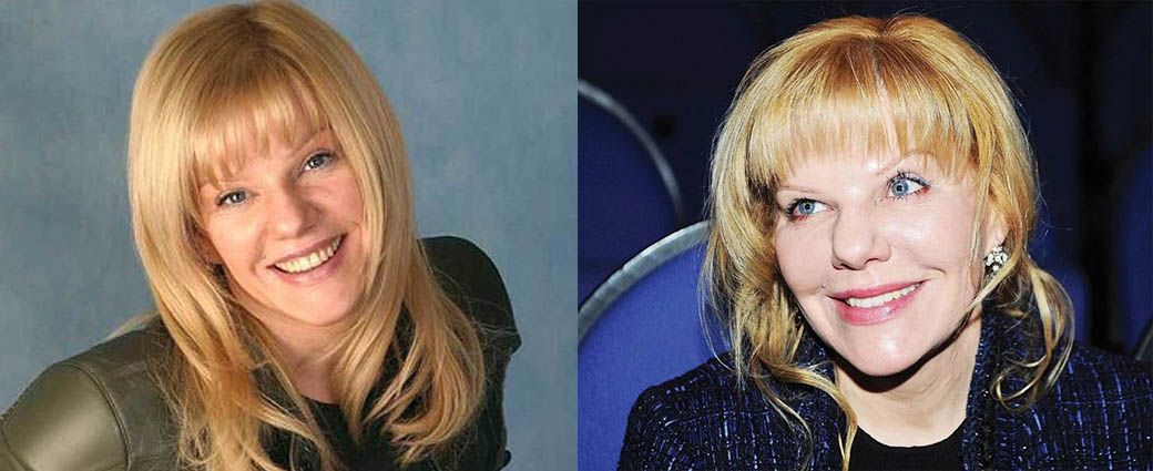 Александра Захарова подтяжка