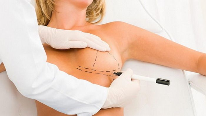 Методика проведения аугментационной маммопластики