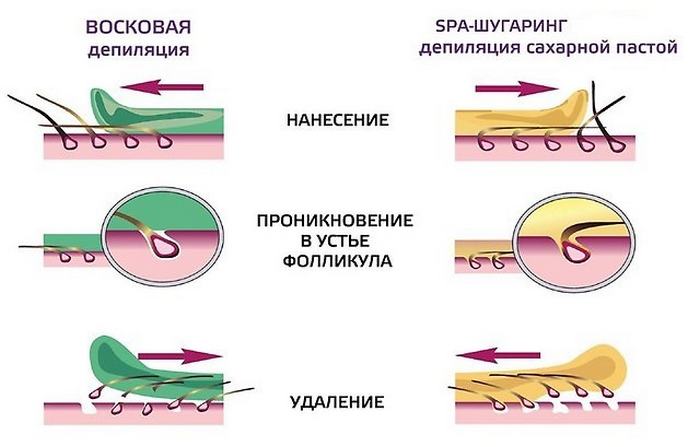 Разница между воском и&nbsp;шугарингом