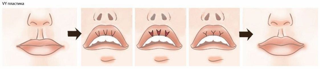 Пластика типа V-Y