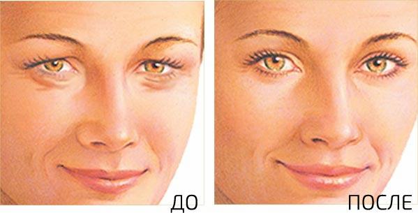 Глаза до&nbsp;и&nbsp;после кантопластики