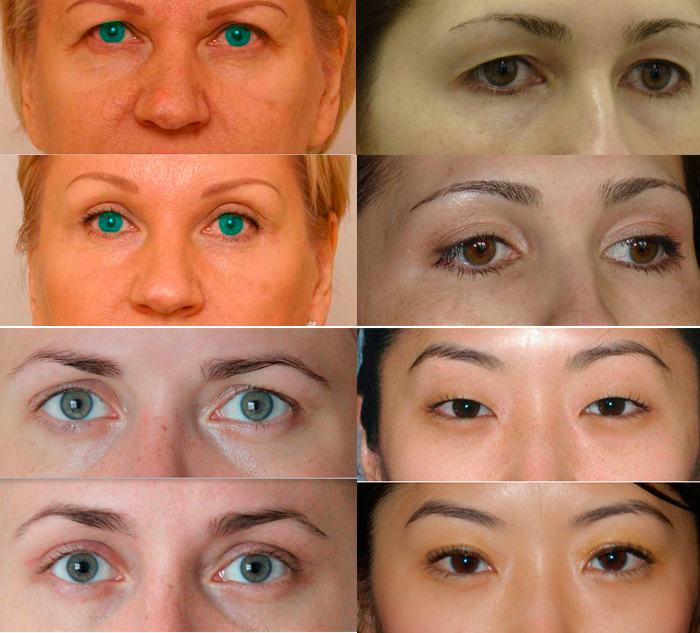 Фото до&nbsp;и&nbsp;псоле кантопексии