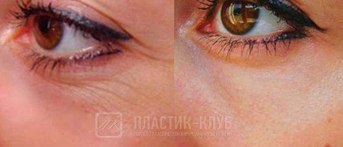 Фото до и после курса процедур коллагенарий