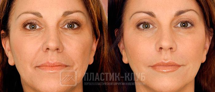 Фото до и после курса процедур коллагенарий
