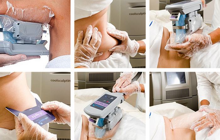 Технология выполнения криолиполиза