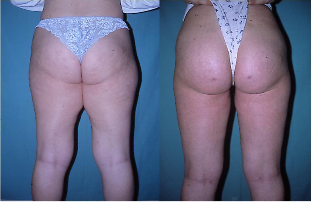 Липолифтинг голени и ягодиц