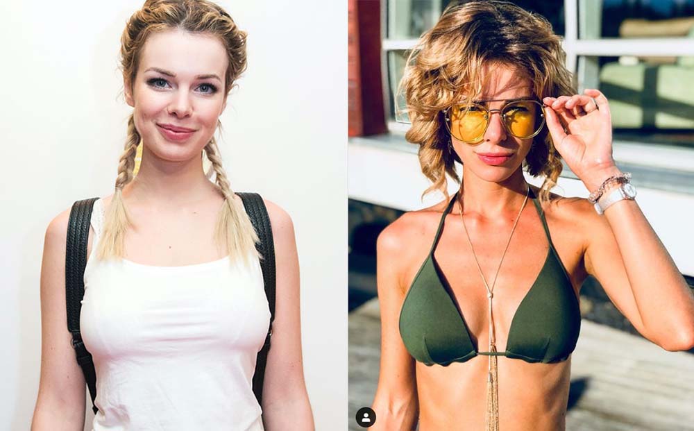 Анна Старшенбаум до и после пластики