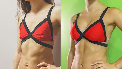 Качественный липофилинг груди: фото до&nbsp;после